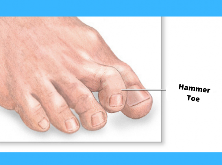 Hammer Toe