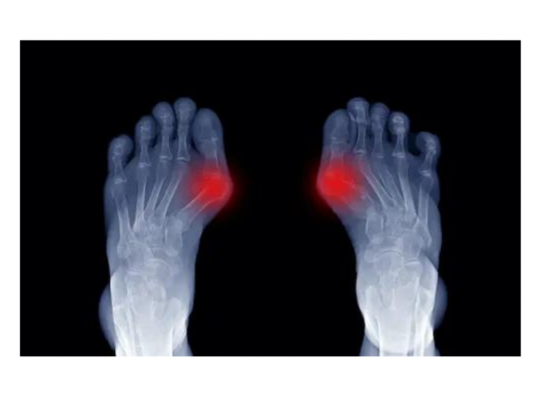 bunion treatment